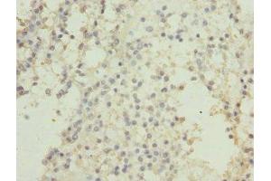 Immunohistochemistry of paraffin-embedded human breast cancer using ABIN7146876 at dilution of 1:100