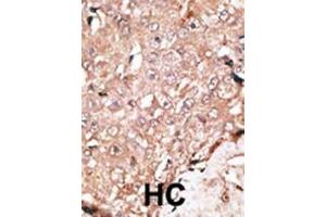 Formalin-fixed and paraffin-embedded human cancer tissue reacted with the primary antibody, which was peroxidase-conjugated to the secondary antibody, followed by DAB staining. (LSD1 抗体  (C-Term))