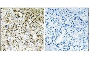 Immunohistochemistry analysis of paraffin-embedded human liver carcinoma tissue, using PPHLN Antibody. (PPHLN1 抗体  (AA 71-120))