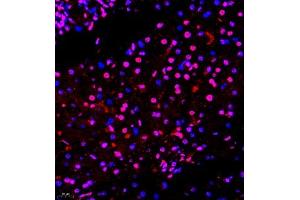 Immunofluorescence of paraffin embedded human liver cancer using smad62024 (ABIN7075629) at dilution of 1:1000 (400x lens) (SMAD6 抗体)