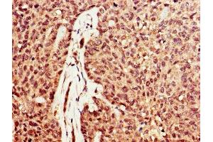 IHC image of ABIN7149726 diluted at 1:600 and staining in paraffin-embedded human ovarian cancer performed on a Leica BondTM system. (DNASE1 抗体  (AA 78-231))