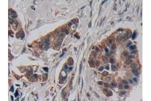 Detection of CRF in Human Breast cancer Tissue using Polyclonal Antibody to Corticotropin Releasing Factor (CRF) (CRH 抗体  (AA 40-195))