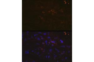 Immunofluorescence analysis of human breast cancer using PD-L1/CD274 Rabbit pAb (ABIN6129976, ABIN6138153, ABIN6138154 and ABIN6215142) at dilution of 1:100 (40x lens). (PD-L1 抗体  (AA 19-238))