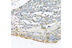 Immunohistochemistry of paraffin-embedded human lung cancer using PRSS1 antibody at dilution of 1:100 (40x lens). (PRSS1 抗体)