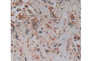 IHC-P analysis of breast cancer tissue, with DAB staining. (PRCP 抗体  (AA 108-376))