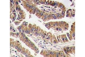 IHC analysis of FFPE human lung carcinoma tissue stained with BMP4 antibody (BMP4 抗体  (AA 5-34))
