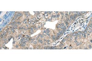 Immunohistochemistry of paraffin-embedded Human gastric cancer tissue using CDADC1 Polyclonal Antibody at dilution of 1:60(x200) (CDADC1 抗体)