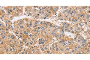 Immunohistochemistry of paraffin-embedded Human liver cancer tissue using ARMCX1 Polyclonal Antibody at dilution 1:40 (ARMCX1 抗体)