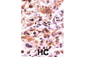 Immunohistochemistry (IHC) image for anti-FGFR (pTyr766) antibody (ABIN3001757) (FGFR (pTyr766) 抗体)