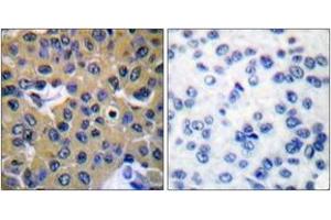 Immunohistochemistry analysis of paraffin-embedded human breast carcinoma, using SHP-2 (Phospho-Tyr542) Antibody. (PTPN11 抗体  (pTyr542))