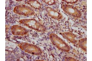 IHC image of ABIN7127403 diluted at 1:100 and staining in paraffin-embedded human colon cancer performed on a Leica BondTM system. (Recombinant CD46 抗体)
