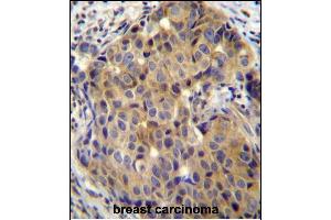 ST14 Antibody (C-term) (ABIN652185 and ABIN2840675) immunohistochemistry analysis in formalin fixed and paraffin embedded human breast carcinoma followed by peroxidase conjugation of the secondary antibody and DAB staining. (ST14 抗体  (C-Term))