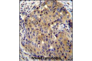 ST14 Antibody (C-term) (ABIN652185 and ABIN2840675) immunohistochemistry analysis in formalin fixed and paraffin embedded human breast carcinoma followed by peroxidase conjugation of the secondary antibody and DAB staining. (ST14 抗体  (C-Term))