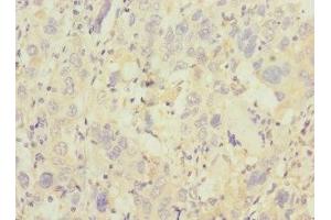 Immunohistochemistry of paraffin-embedded human liver cancer using ABIN7172186 at dilution of 1:100 (TRHDE 抗体  (AA 62-200))
