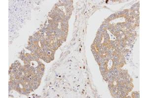 IHC-P Image Immunohistochemical analysis of paraffin-embedded OVCA xenograft, using MSTO1, antibody at 1:100 dilution. (MSTO1 抗体  (Center))