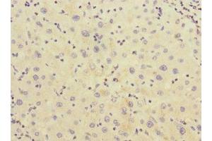 Immunohistochemistry of paraffin-embedded human liver cancer using ABIN7142967 at dilution of 1:100 (CHRNE 抗体  (AA 21-239))