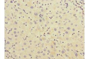 Immunohistochemistry of paraffin-embedded human liver cancer using ABIN7142967 at dilution of 1:100 (CHRNE 抗体  (AA 21-239))