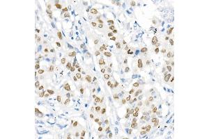 Immunohistochemistry of paraffin-embedded Human lung adenocarcinoma using TTF1 antibody (ABIN1679475, ABIN3017648, ABIN3017649 and ABIN7101514) at dilution of 1:1000 (40x lens).