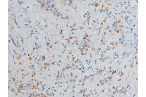 ABIN6268776 at 1/200 staining human breast cancer tissue sections by IHC-P. (MMP 9 抗体  (C-Term))