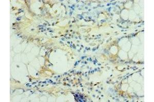 Immunohistochemistry of paraffin-embedded human colon cancer using ABIN7159382 at dilution of 1:100