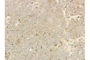 ABIN6266219 and ABIN6277379 at 1/100 staining human melanoma by IHC-P. (GRK1 抗体  (N-Term))