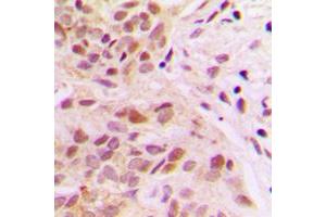 Immunohistochemical analysis of Rpb1 CTD (pSer5) staining in human breast cancer formalin fixed paraffin embedded tissue section. (Rpb1 CTD 抗体  (C-Term, pSer5))