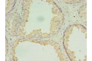 Immunohistochemistry of paraffin-embedded human prostate cancer using ABIN7150902 at dilution of 1:100 (CCDC135 抗体  (AA 1-300))