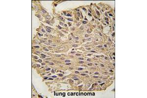 Formalin-fixed and paraffin-embedded human lung carcinoma tissue reacted with ALDOA antibody , which was peroxidase-conjugated to the secondary antibody, followed by DAB staining. (ALDOA 抗体  (C-Term))