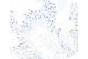 Immunohistochemistry of paraffin-embedded Human mammary cancer using CREM Polyclonal Antibody at dilution of 1:100 (40x lens). (CREM 抗体)