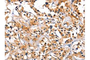 The image on the left is immunohistochemistry of paraffin-embedded Human thyroid cancer tissue using ABIN7128916(CEP97 Antibody) at dilution 1/40, on the right is treated with fusion protein. (CEP97 抗体)