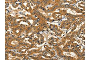 The image on the left is immunohistochemistry of paraffin-embedded Human thyroid cancer tissue using ABIN7128251(ADCY3 Antibody) at dilution 1/50, on the right is treated with fusion protein.