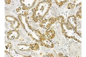 Annexin A2 Mouse Monoclonal Antibody at 1/100 staining human ovarian cancer by IHC-P. (Annexin A2 抗体  (Internal Region))