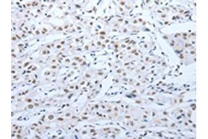The image on the left is immunohistochemistry of paraffin-embedded Human lung cancer tissue using ABIN7189621(ACIN1 Antibody) at dilution 1/30, on the right is treated with synthetic peptide. (ACIN1 抗体)