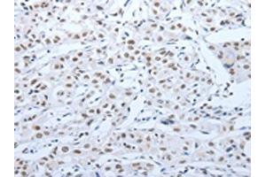 The image on the left is immunohistochemistry of paraffin-embedded Human lung cancer tissue using ABIN7189621(ACIN1 Antibody) at dilution 1/30, on the right is treated with synthetic peptide.
