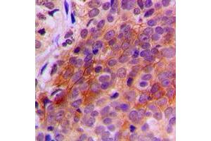 Immunohistochemical analysis of TXNRD2 staining in human breast cancer formalin fixed paraffin embedded tissue section. (TXNRD2 抗体  (C-Term))
