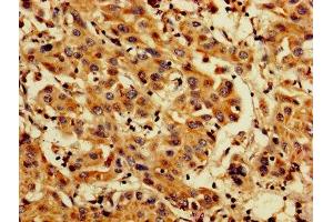 IHC image of ABIN7164696 diluted at 1:200 and staining in paraffin-embedded human liver cancer performed on a Leica BondTM system.