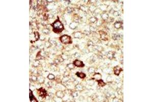 Formalin-fixed and paraffin-embedded human cancer tissue reacted with the primary antibody, which was peroxidase-conjugated to the secondary antibody, followed by AEC staining. (FGFR4 抗体  (N-Term))