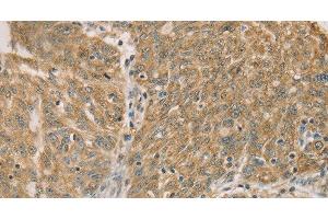 Immunohistochemistry of paraffin-embedded Human ovarian cancer using DMRT3 Polyclonal Antibody at dilution of 1:50 (DMRT3 抗体)