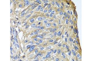 Immunohistochemistry of paraffin-embedded Human prostate cancer using APOA1 Polyclonal Antibody at dilution of 1:100 (40x lens). (APOA1 抗体)