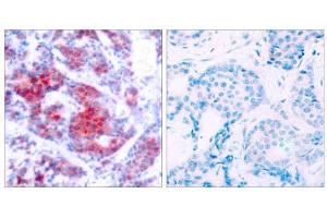Immunohistochemical analysis of paraffin-embedded human breast carcinoma tissue using STAT4 (phospho-Tyr693) antibody (E011047). (STAT4 抗体  (pTyr693))