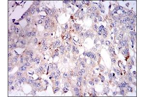 Immunohistochemical analysis of paraffin-embedded esophageal cancer tissues using PLIN2 mouse mAb with DAB staining. (ADRP 抗体  (AA 286-437))