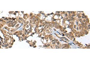Immunohistochemistry of paraffin-embedded Human ovarian cancer tissue using SPRTN Polyclonal Antibody at dilution of 1:65(x200) (Spartan 抗体)