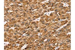 The image on the left is immunohistochemistry of paraffin-embedded Human liver cancer tissue using ABIN7192683(STK32B Antibody) at dilution 1/25, on the right is treated with synthetic peptide. (STK32B 抗体)