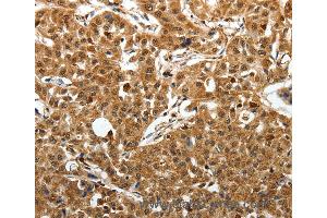 Immunohistochemistry of Human lung cancer using SOX13 Polyclonal Antibody at dilution of 1:50 (SOX13 抗体)