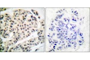 Immunohistochemistry analysis of paraffin-embedded human breast carcinoma, using MEF2A (Phospho-Thr319) Antibody. (MEF2A 抗体  (pThr319))