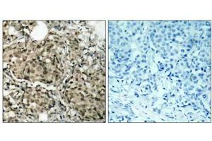 Immunohistochemical analysis of paraffin-embedded human breast carcinoma tissue using G3BP-1 (Ab-232) antibody (E021102).