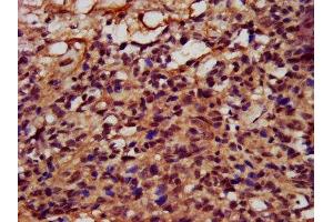 IHC image of ABIN7152727 diluted at 1:400 and staining in paraffin-embedded human ovarian cancer performed on a Leica BondTM system. (FATE1 抗体  (AA 1-162))