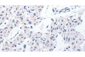 Immunohistochemistry of paraffin-embedded Human lung cancer using POMC Polyclonal Antibody at dilution of 1:30 (POMC 抗体)
