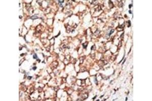 IHC analysis of FFPE human hepatocarcinoma tissue stained with the BMPR1B antibody (BMPR1B 抗体  (AA 472-502))