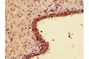 Immunohistochemistry of paraffin-embedded human prostate cancer using ABIN7166309 at dilution of 1:100 (WNT7A 抗体  (AA 126-302))
